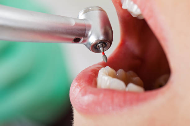 Best Emergency Root Canal Therapy in Poydras, LA